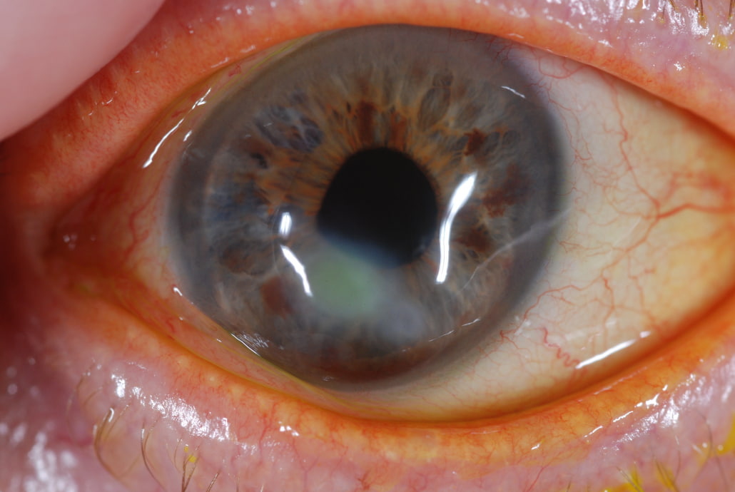 What is Corneal Ectasia and How to Manage it OBN